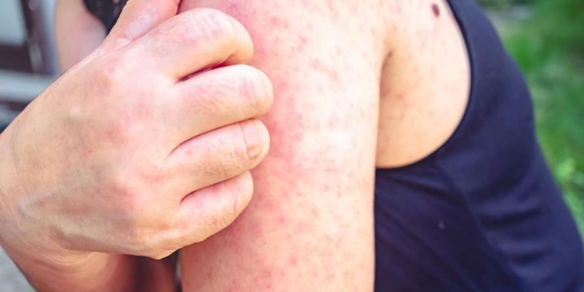 Fifteen Measles Cases Reported in West Texas County Amid High Vaccine Exemptions